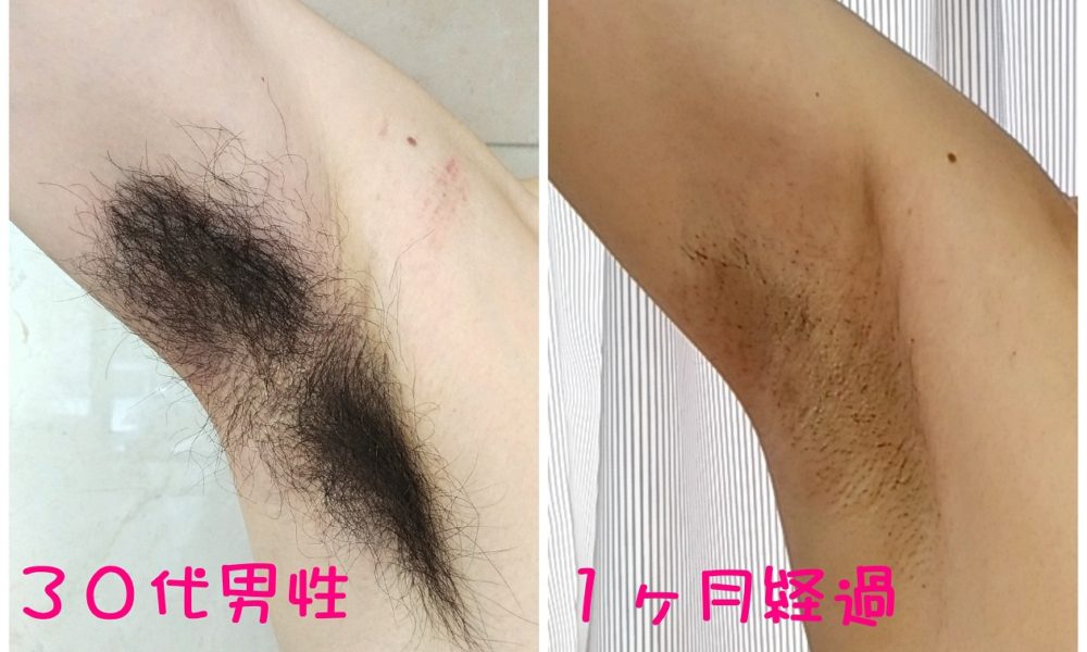 Before After 脱毛サロンsoi