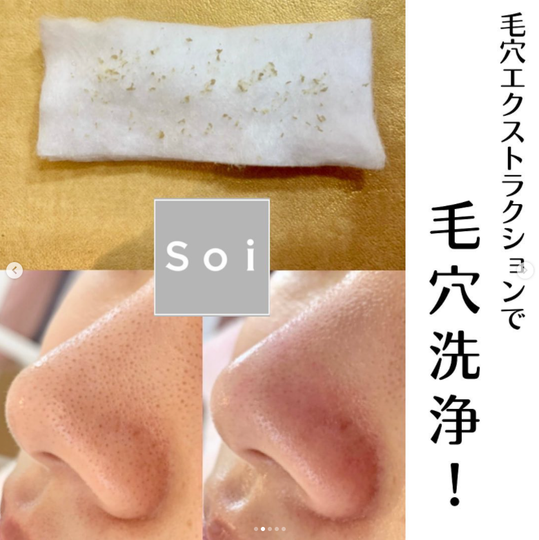 毛穴の黒ずみケアのミストが登場！ | 脱毛サロンSoi